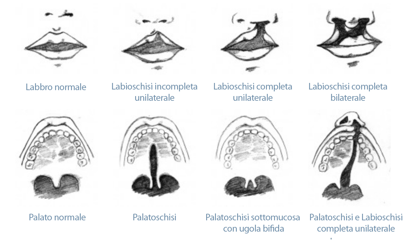 Labioschisi, palatoschisi e labiopalatoschisi: informazioni sulle malformazioni e sull’intervento