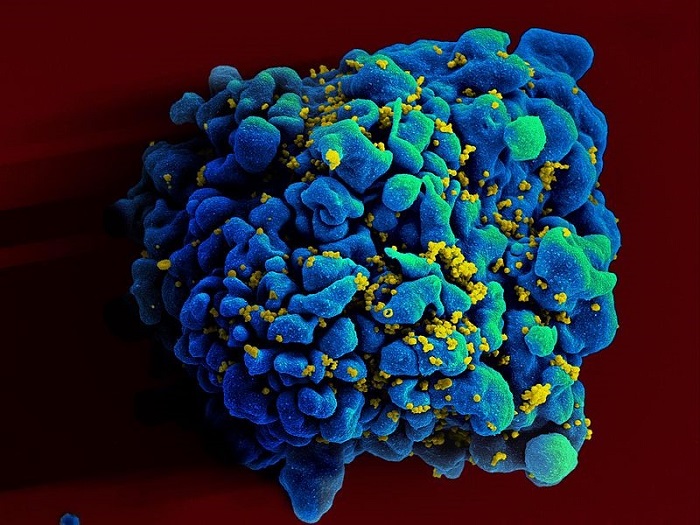 Nascere e vivere da sieropositivi: HIV, trasmissione verticale, nuove cure funzionali e vaccino Tat.
